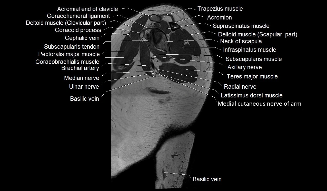 Upper arm (humerus ) saittal cross sectional anatomy 3T image 28.webp